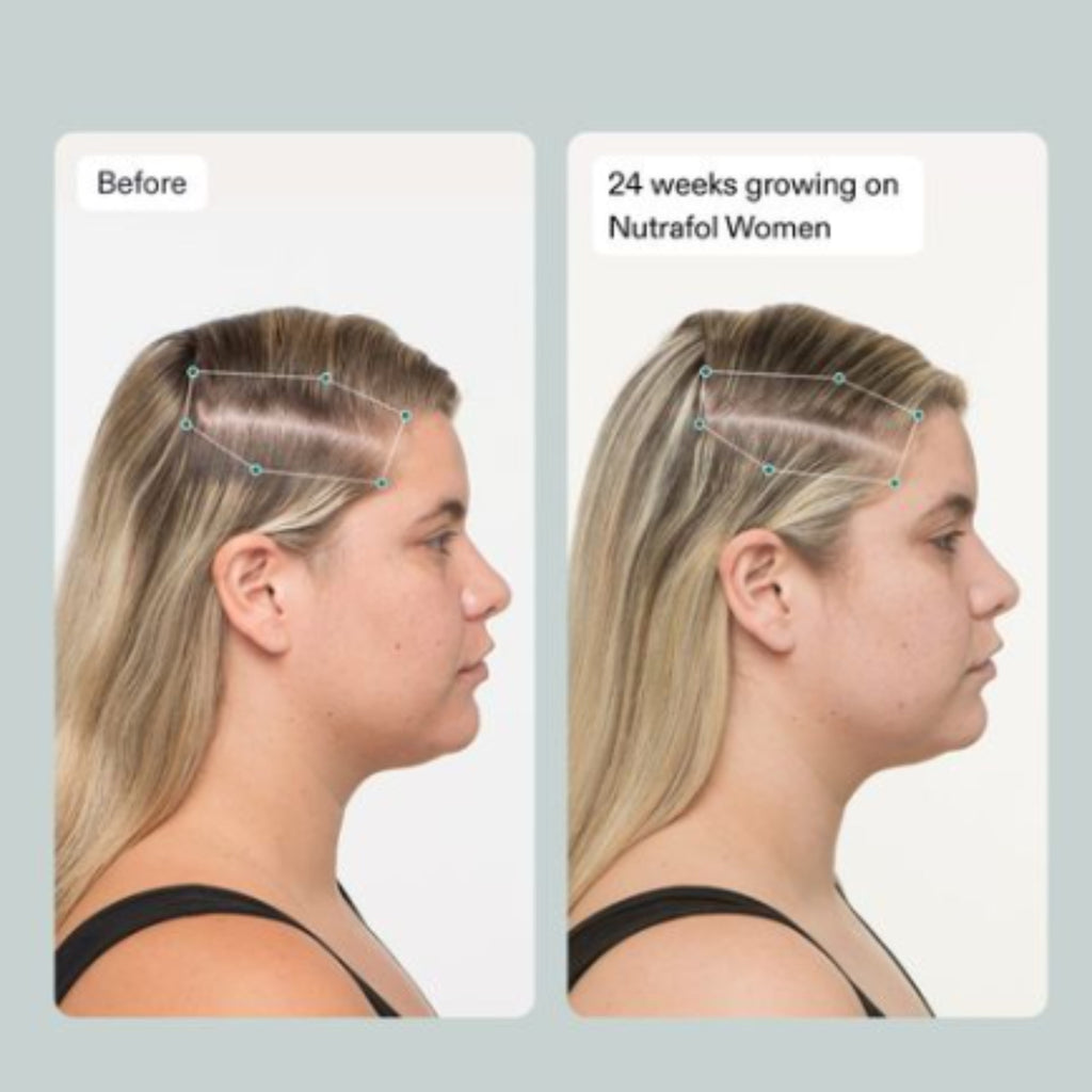 Nutrafol Women’s Balance Hair Growth Gift Pack 3-Pack – Advanced Hair Wellness for Women 45+
